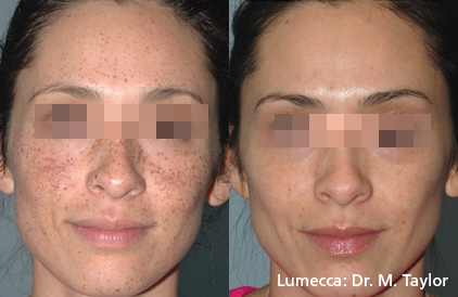 IPL - BEFORE AND AFTER 3