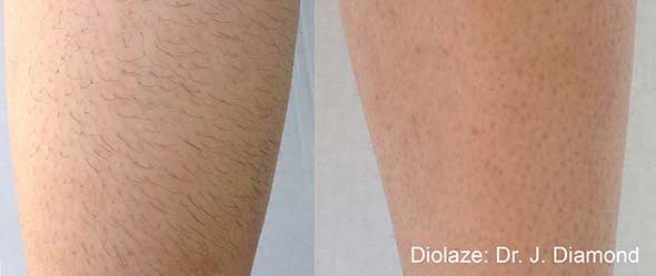 Laser Hair Removal - before and after 1