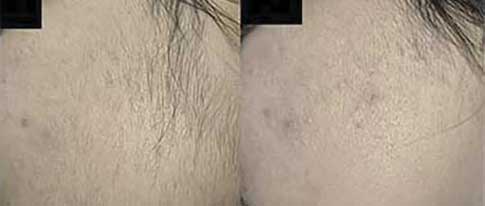 Laser Hair Removal - before and after 2