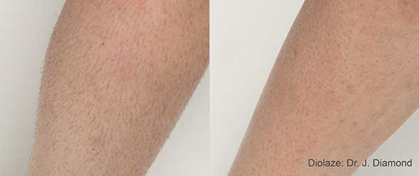 Laser Hair Removal - before and after 3